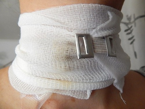 Neck Warts Treatment2