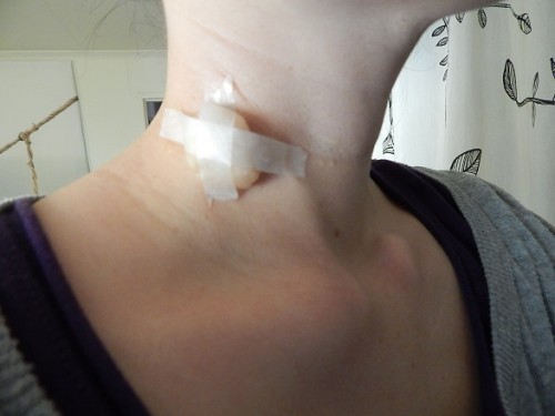 Removing Warts With Apple Cider Vinegar1