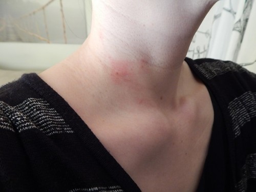 Removing Warts With Apple Cider Vinegar2