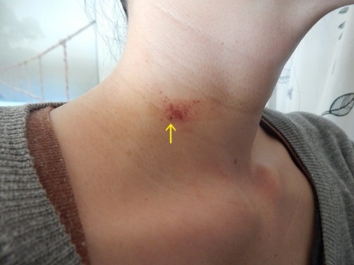 Removing Warts With Apple Cider Vinegar4