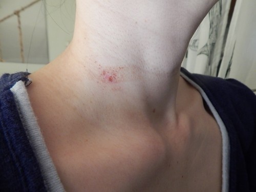 Removing Warts With Apple Cider Vinegar5