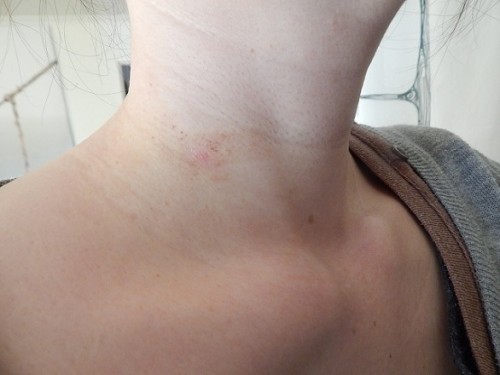 Removing Warts With Apple Cider Vinegar6
