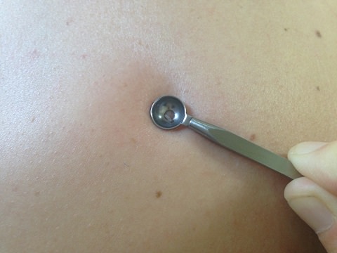 Blackhead Removal Tool5