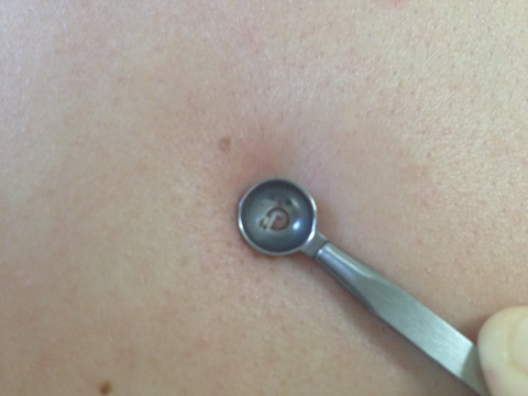 Blackhead Removal Tool6
