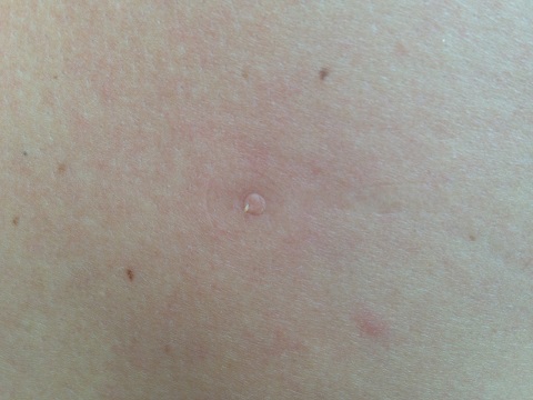 blackhead-removal-tool7